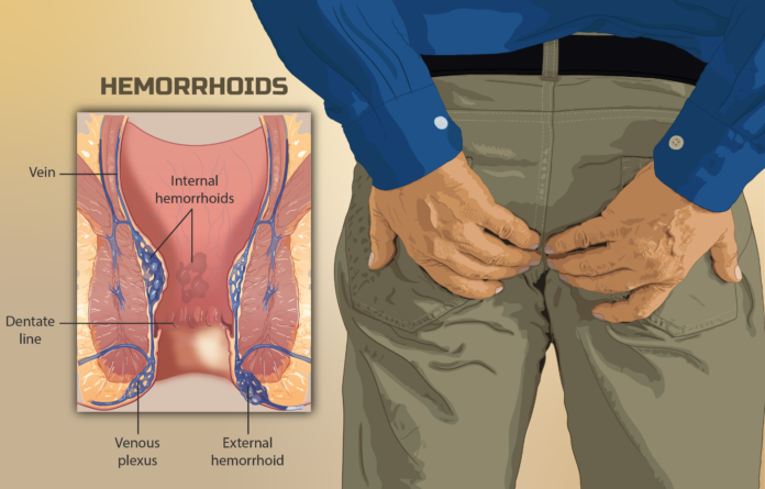 Hemorrhoids: Symptoms, Causes & Treatment